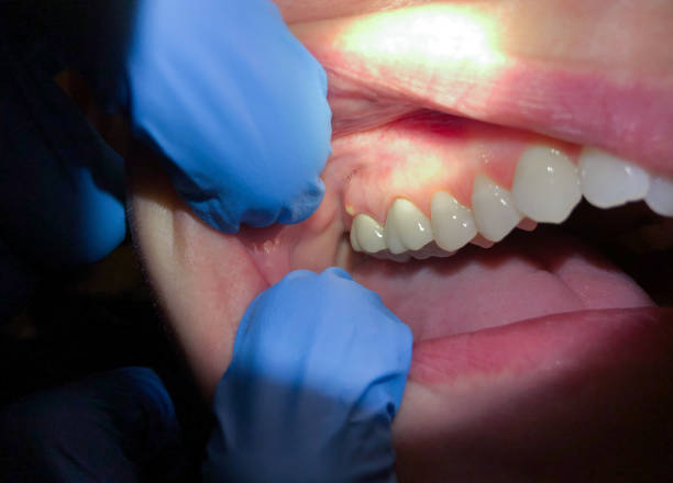 Best Emergency Gum Treatment in Riverton, WY